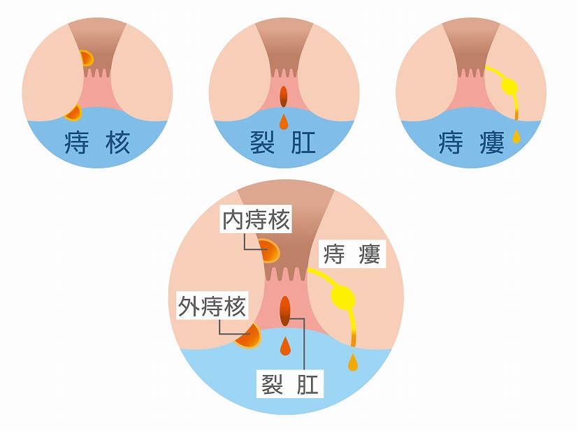肛門内科でよくある疾患